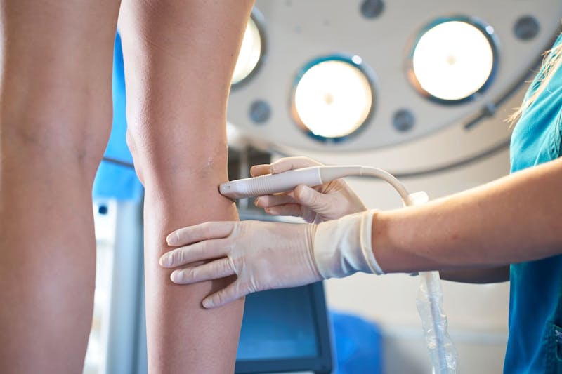vbeam vein treatment