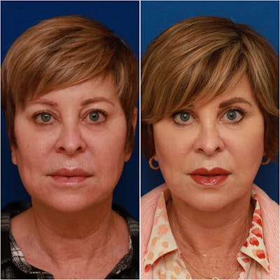 Facelift Before & After Gallery - Patient 58233149 - Image 1