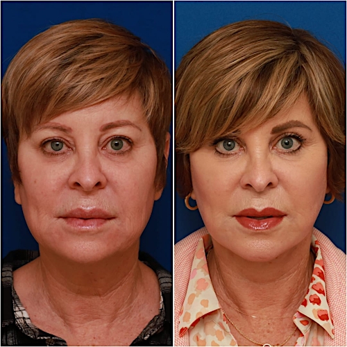 Neck Lift Before & After Gallery - Patient 773126 - Image 1