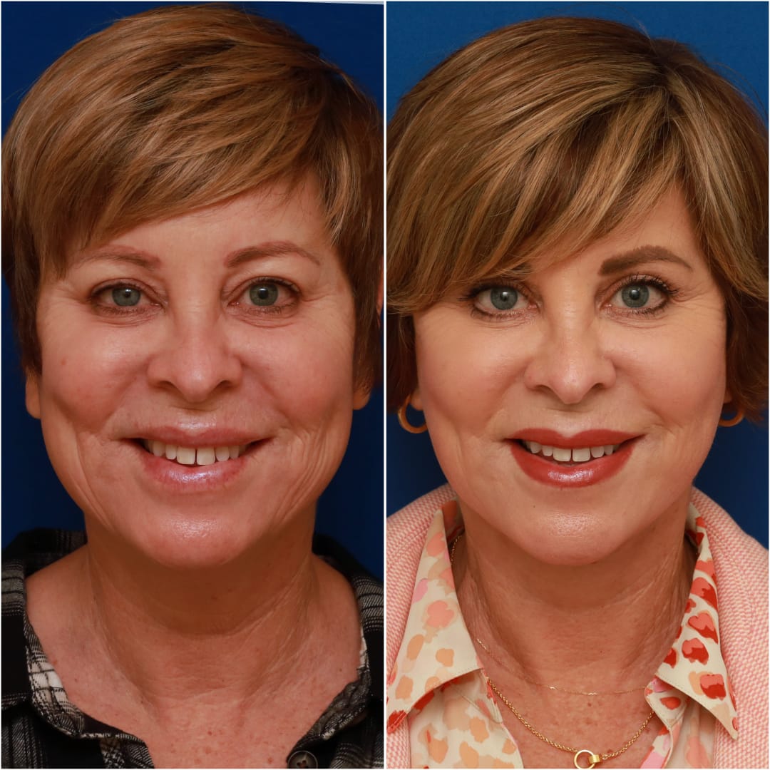Facelift Before & After Gallery - Patient 58233149 - Image 2