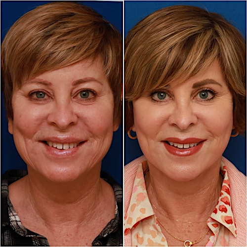 Neck Lift Before & After Gallery - Patient 773126 - Image 2