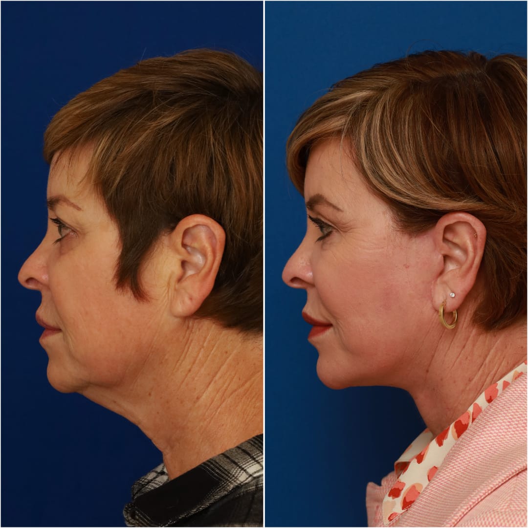 Facelift Before & After Gallery - Patient 58233149 - Image 3