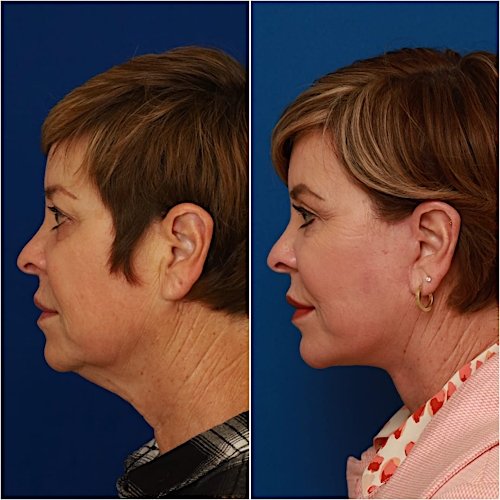 Neck Lift Before & After Gallery - Patient 773126 - Image 3