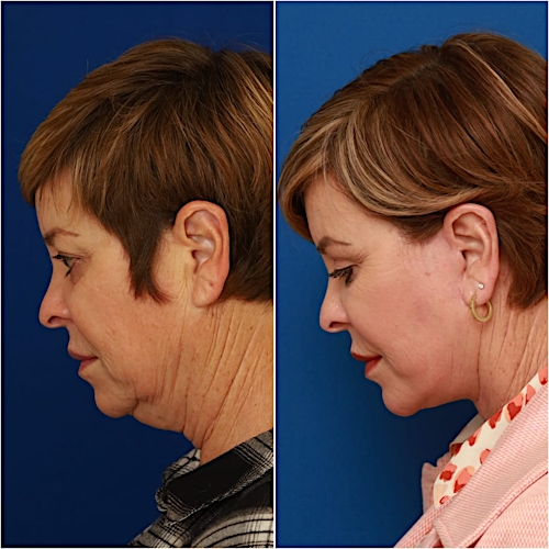 Neck Lift Before & After Gallery - Patient 773126 - Image 4