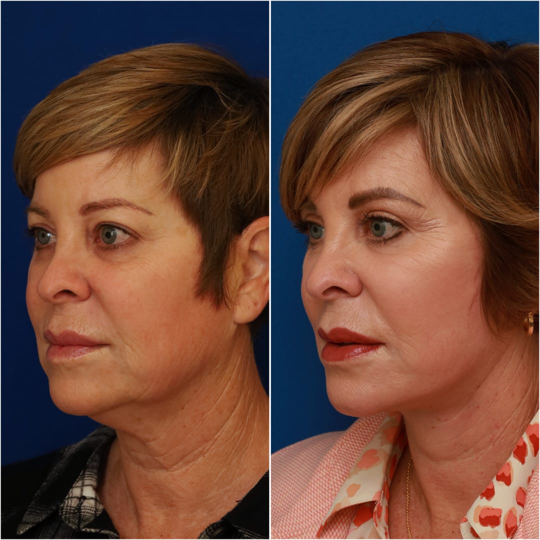 Facelift Before & After Gallery - Patient 58233149 - Image 5