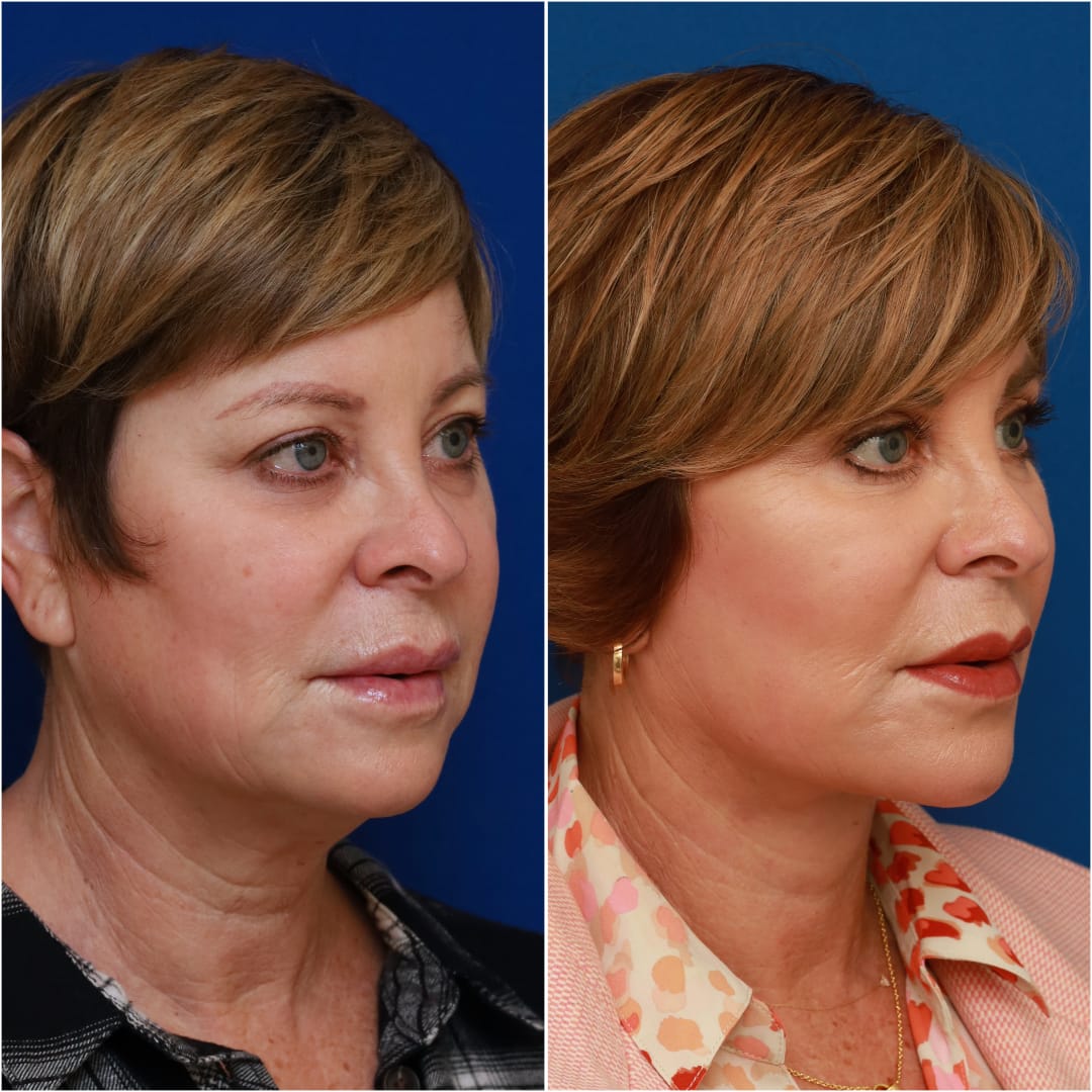 Facelift Before & After Gallery - Patient 58233149 - Image 6