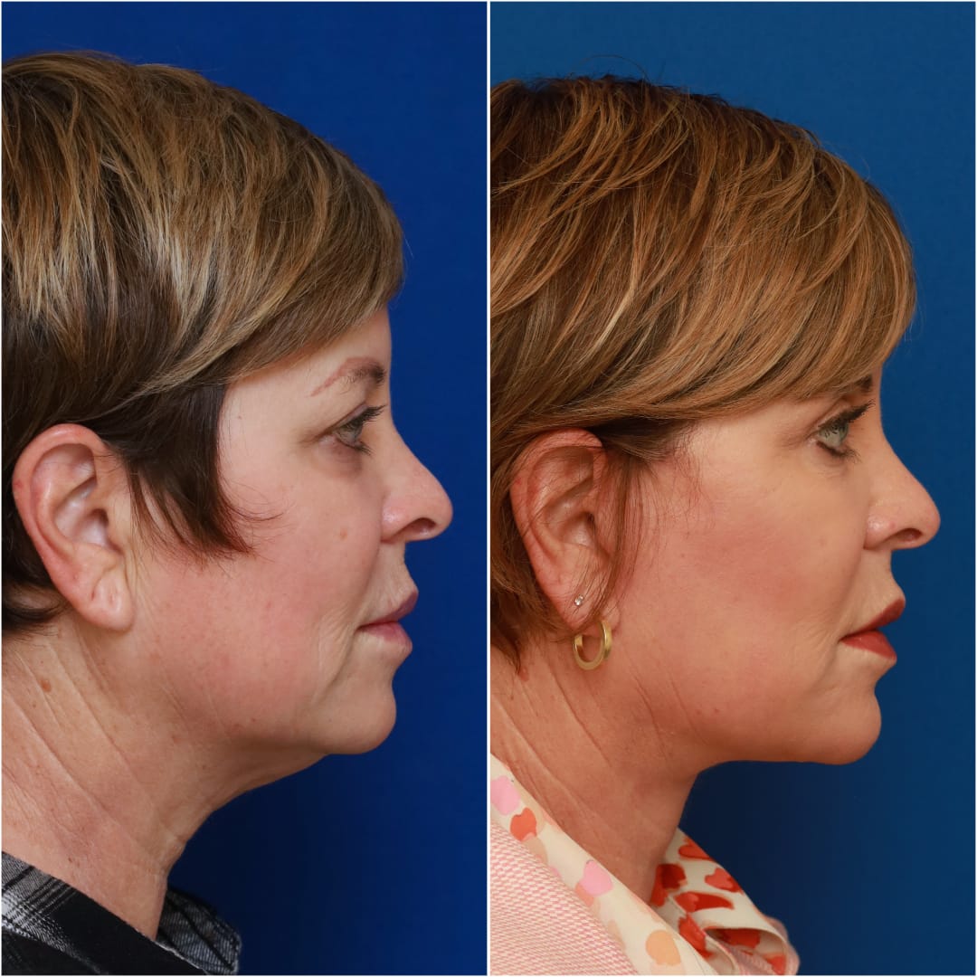 Facelift Before & After Gallery - Patient 58233149 - Image 7