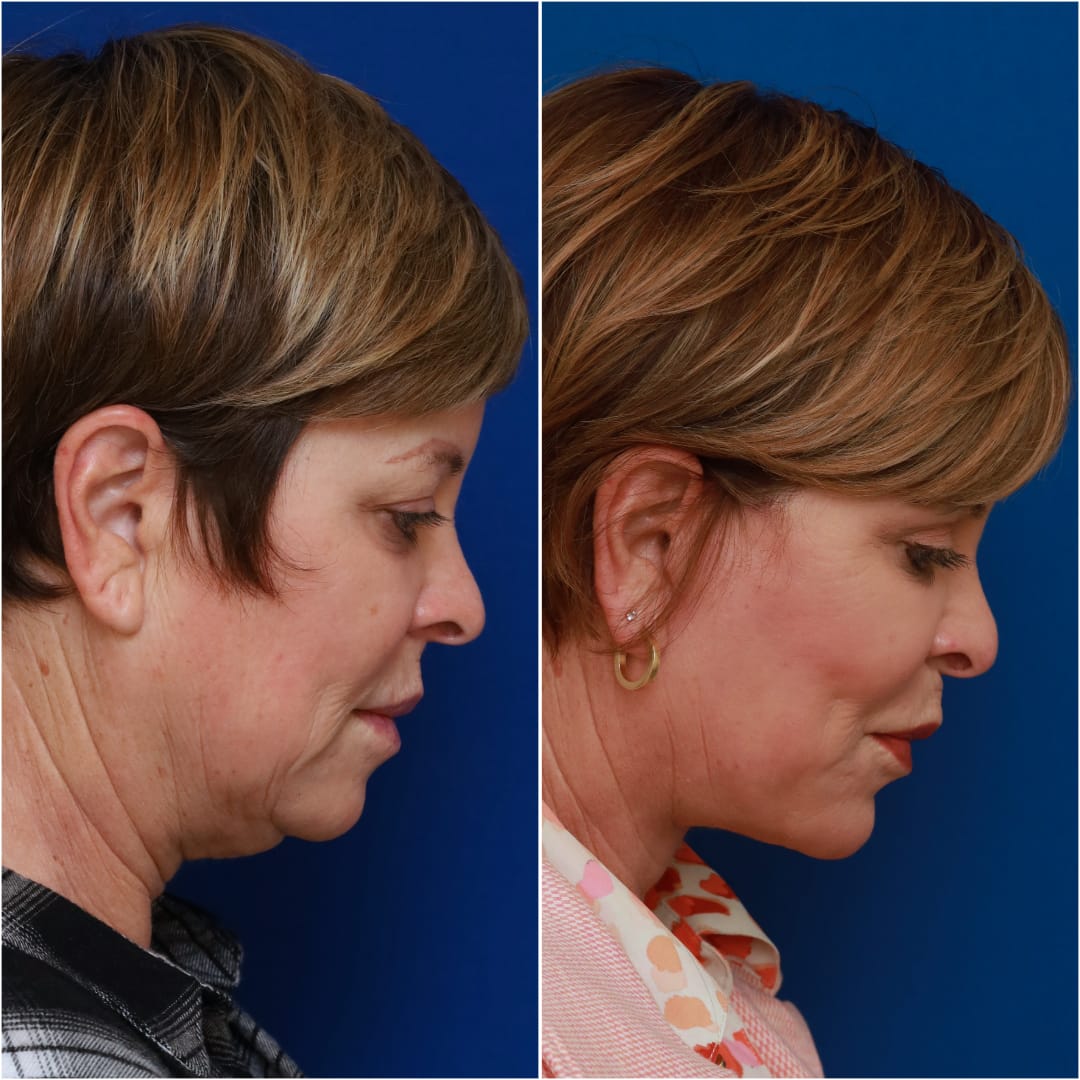 Facelift Before & After Gallery - Patient 58233149 - Image 8