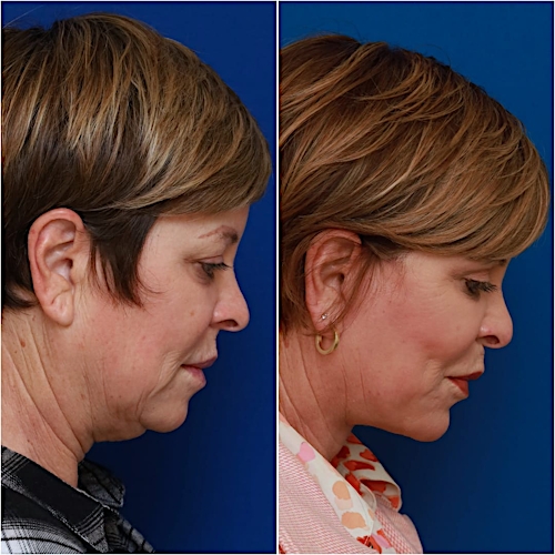 Neck Lift Before & After Gallery - Patient 773126 - Image 8