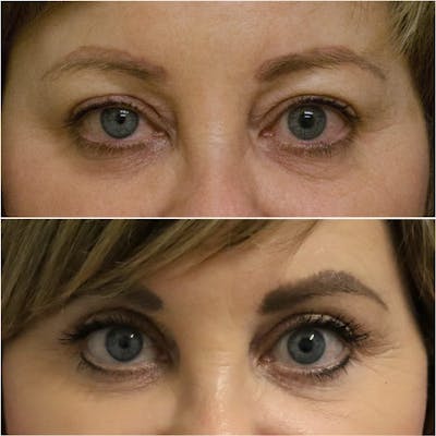 Blepharoplasty Before & After Gallery - Patient 58233201 - Image 1