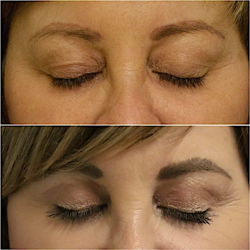 Blepharoplasty Before & After Gallery - Patient 58233201 - Image 2