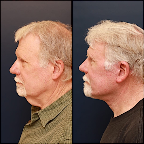 Neck Lift Before & After Gallery - Patient 123356 - Image 3