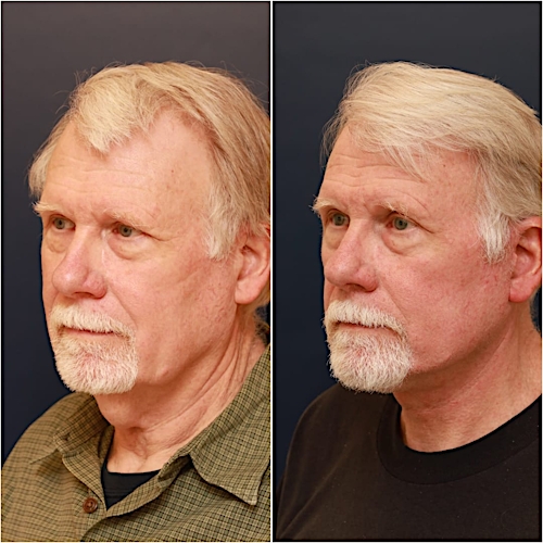 Neck Lift Before & After Gallery - Patient 123356 - Image 2