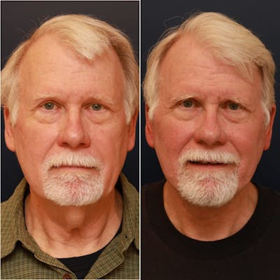 Neck Lift Before & After Gallery - Patient 123356 - Image 1