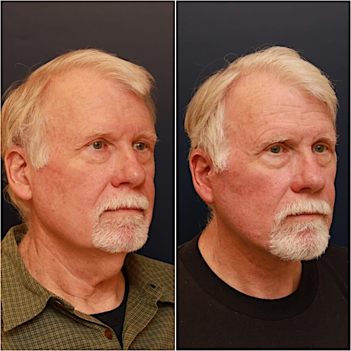 Neck Lift Before & After Gallery - Patient 123356 - Image 4