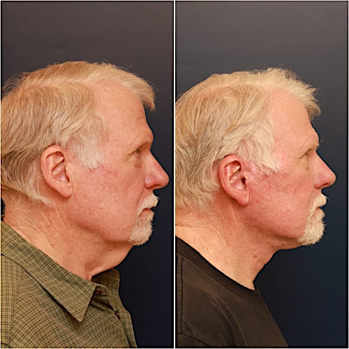Neck Lift Before & After Gallery - Patient 123356 - Image 5