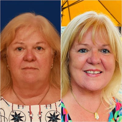 Facelift Before & After Gallery - Patient 58233152 - Image 1