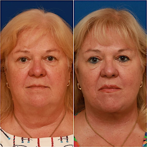 Neck Lift Before & After Gallery - Patient 329388 - Image 2