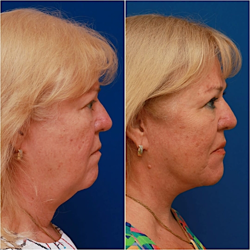Neck Lift Before & After Gallery - Patient 329388 - Image 3