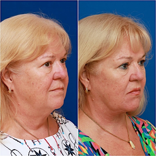 Facelift Before & After Gallery - Patient 58233152 - Image 4