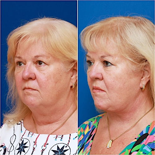 Facelift Before & After Gallery - Patient 58233152 - Image 5