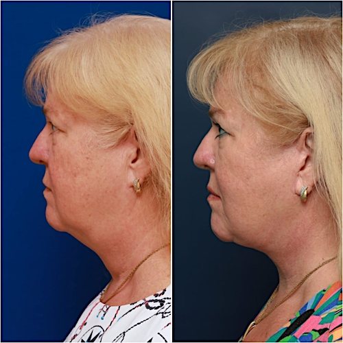 Facelift Before & After Gallery - Patient 58233152 - Image 6