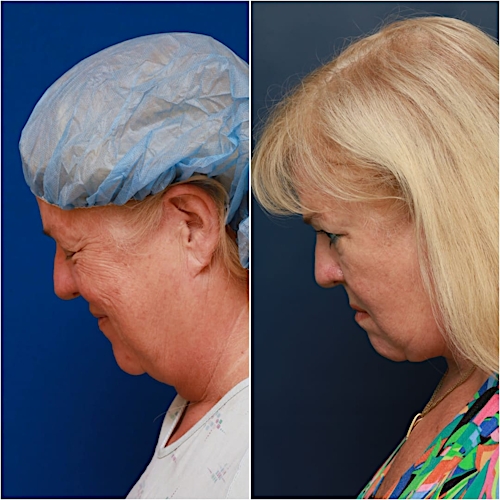 Neck Lift Before & After Gallery - Patient 329388 - Image 7