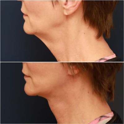 Neck Lift Before & After Gallery - Patient 111453 - Image 1