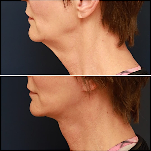 Neck Lift Before & After Gallery - Patient 111453 - Image 1