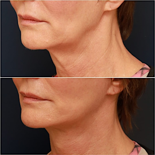 Neck Lift Before & After Gallery - Patient 111453 - Image 2