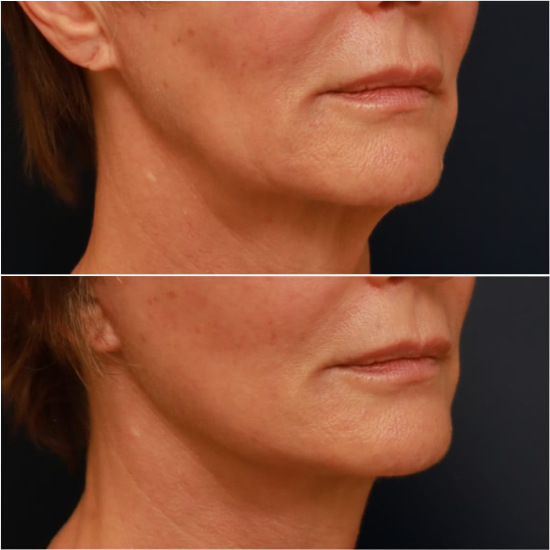 Neck Lift Before & After Gallery - Patient 111453 - Image 3