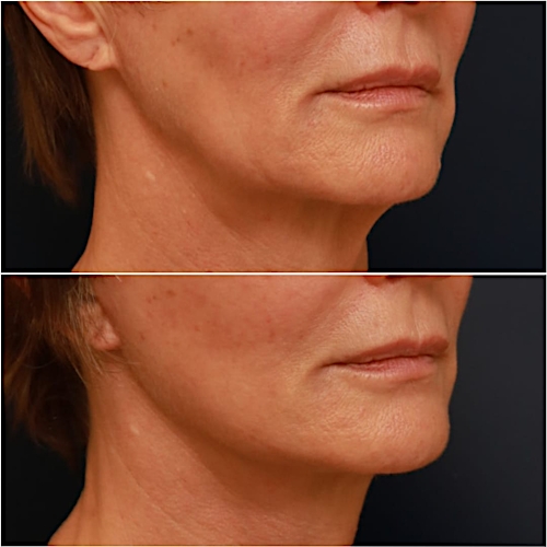 Neck Lift Before & After Gallery - Patient 111453 - Image 3