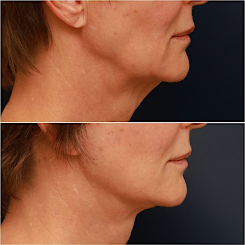 Neck Lift Before & After Gallery - Patient 111453 - Image 4
