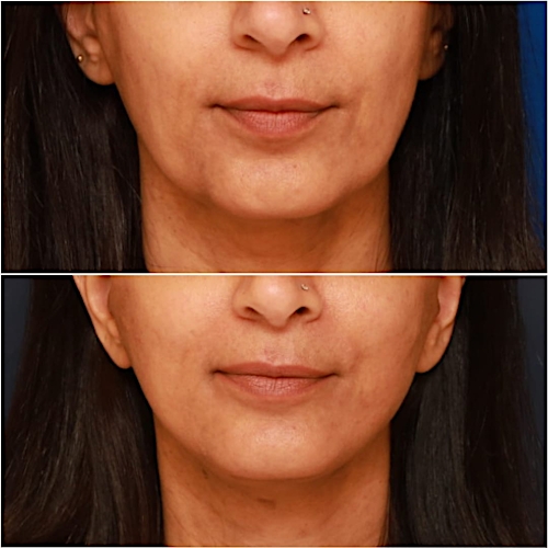 Neck Lift Before & After Gallery - Patient 464298 - Image 1