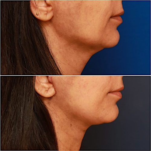 Facelift Before & After Gallery - Patient 58233154 - Image 2