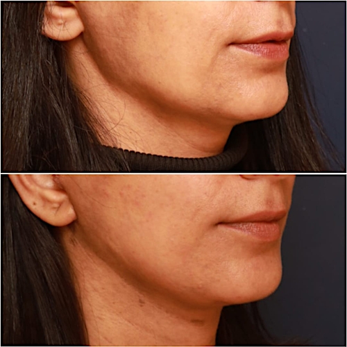 Neck Lift Before & After Gallery - Patient 464298 - Image 3