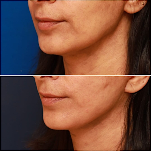 Neck Lift Before & After Gallery - Patient 464298 - Image 4