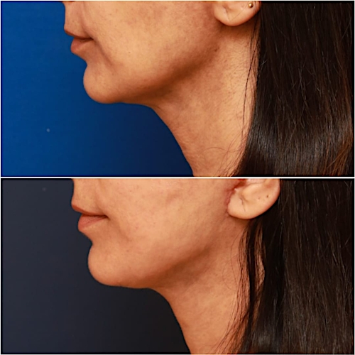 Neck Lift Before & After Gallery - Patient 464298 - Image 5