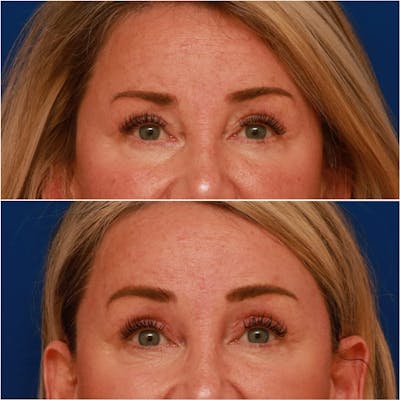 Brow Lift Before & After Gallery - Patient 58233161 - Image 1