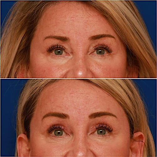 Brow Lift Before & After Gallery - Patient 58233161 - Image 1