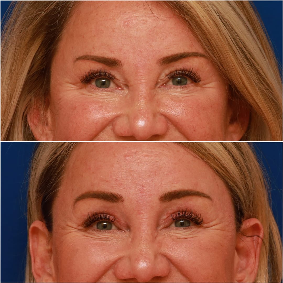Brow Lift Before & After Gallery - Patient 58233161 - Image 2