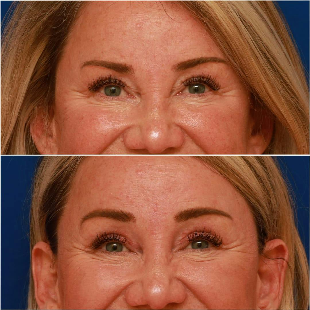 Brow Lift Before & After Gallery - Patient 58233161 - Image 2