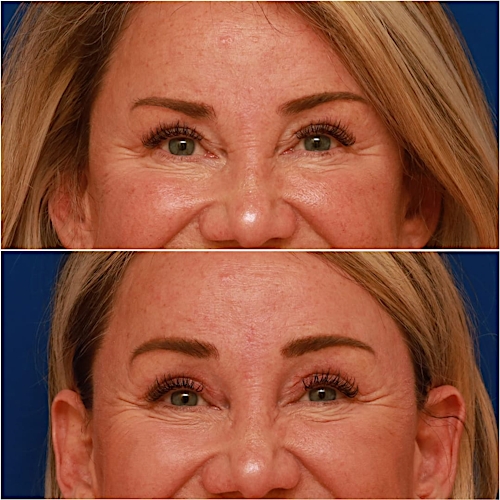 Brow Lift Before & After Gallery - Patient 58233161 - Image 2
