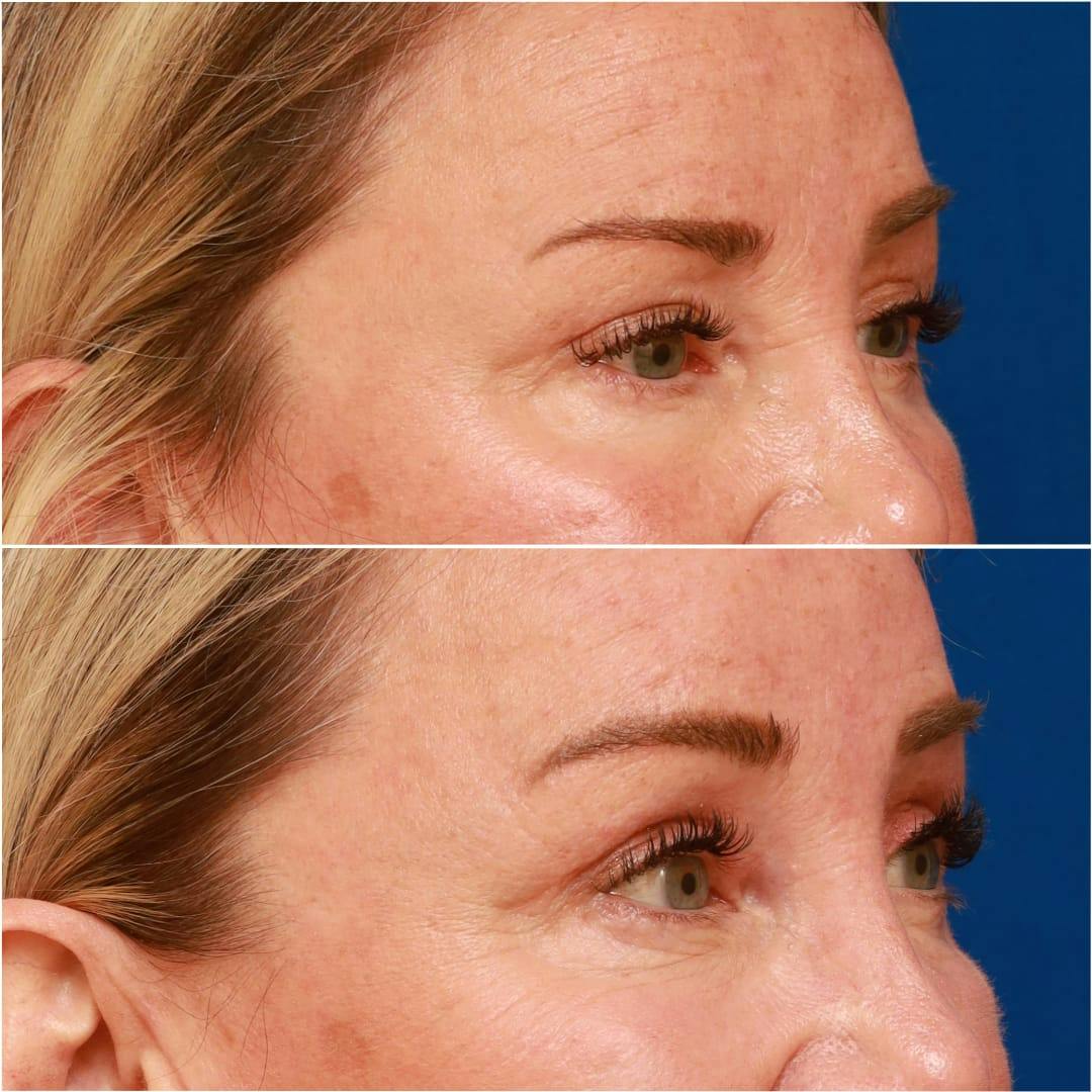 Brow Lift Before & After Gallery - Patient 58233161 - Image 3