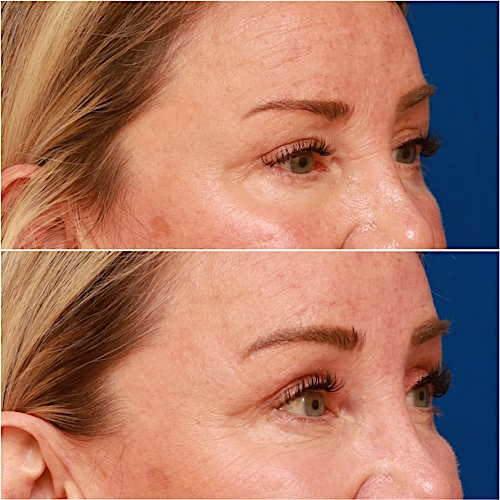 Brow Lift Before & After Gallery - Patient 58233161 - Image 3