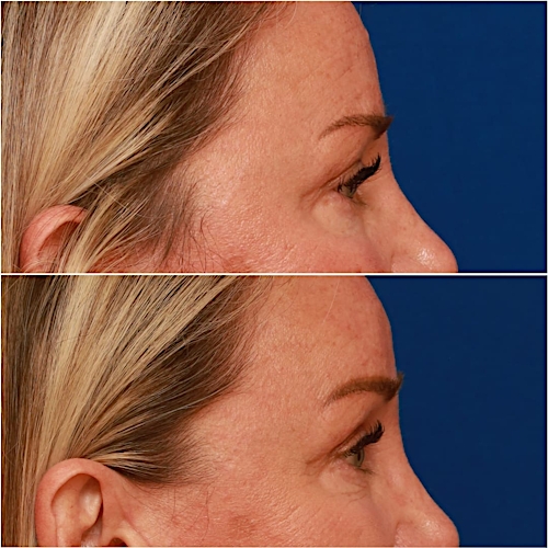 Brow Lift Before & After Gallery - Patient 58233161 - Image 4