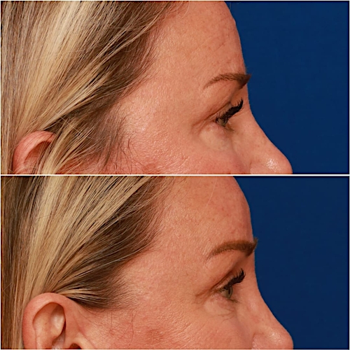Brow Lift Before & After Gallery - Patient 58233161 - Image 4