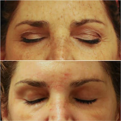 Brow Lift Before & After Gallery - Patient 58233162 - Image 1