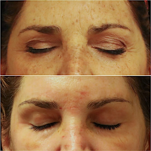 Brow Lift Before & After Gallery - Patient 58233162 - Image 1