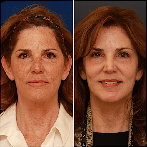 Brow Lift Before & After Gallery - Patient 58233162 - Image 2